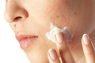 Close-up of acne-prone facial skin with treatment cream